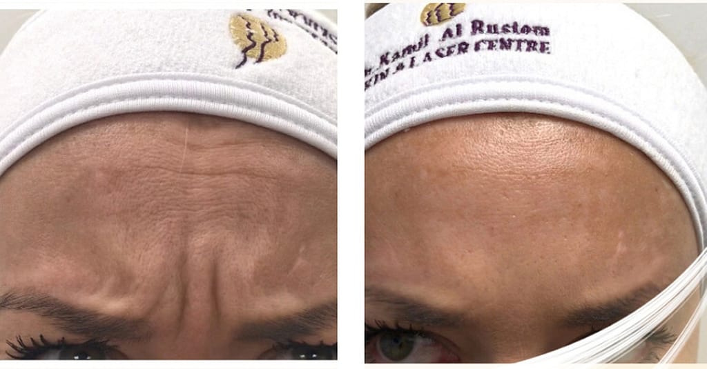Choice Of Botox Injections National Deal other Shop Online at Dubai Trades 4