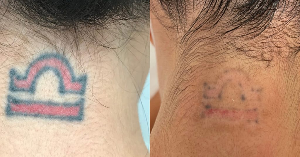 Three Sessions Of Laser Tattoo Removal: Small, Medium, Or Large Area Dubai other Shop Online at Dubai Trades 6